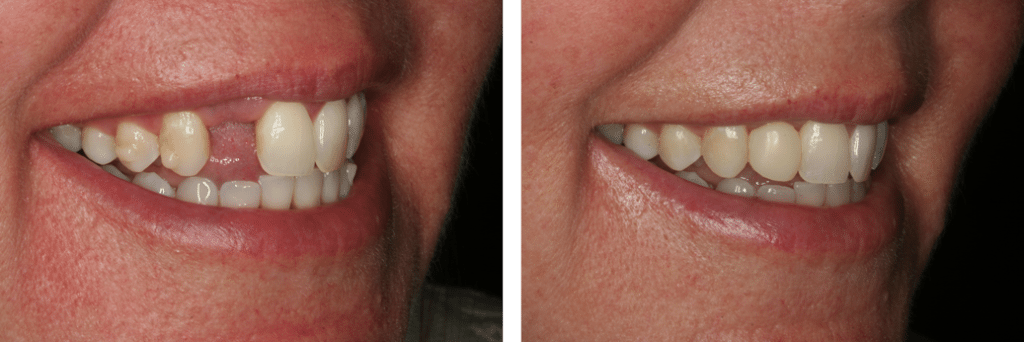 Dental Implants Before and After
