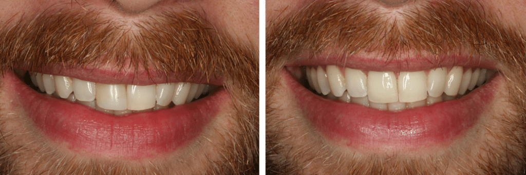 Dental Implants Before and After
