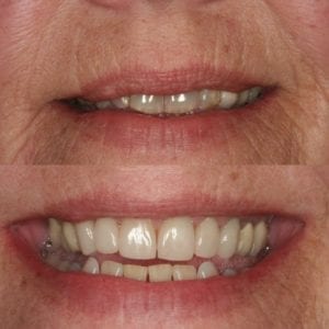 porcelain veneers results