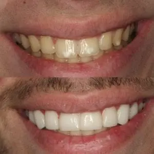 Affordable porcelain veneers in Chester Springs, PA