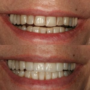 porcelain veneers near me