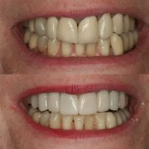 before and after porcelain veneers near me