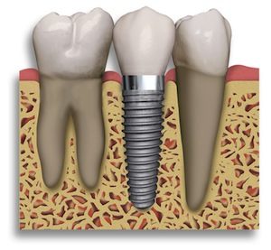 implant dentistry in 19425, Pennsylvania