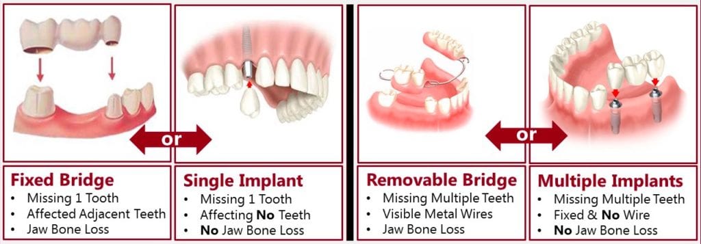 implant-supported dental bridges near me in Chester Springs PA
