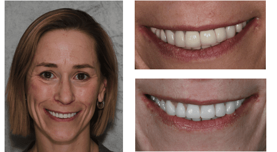 After full mouth rehabilitation near me in Chester Springs, PA