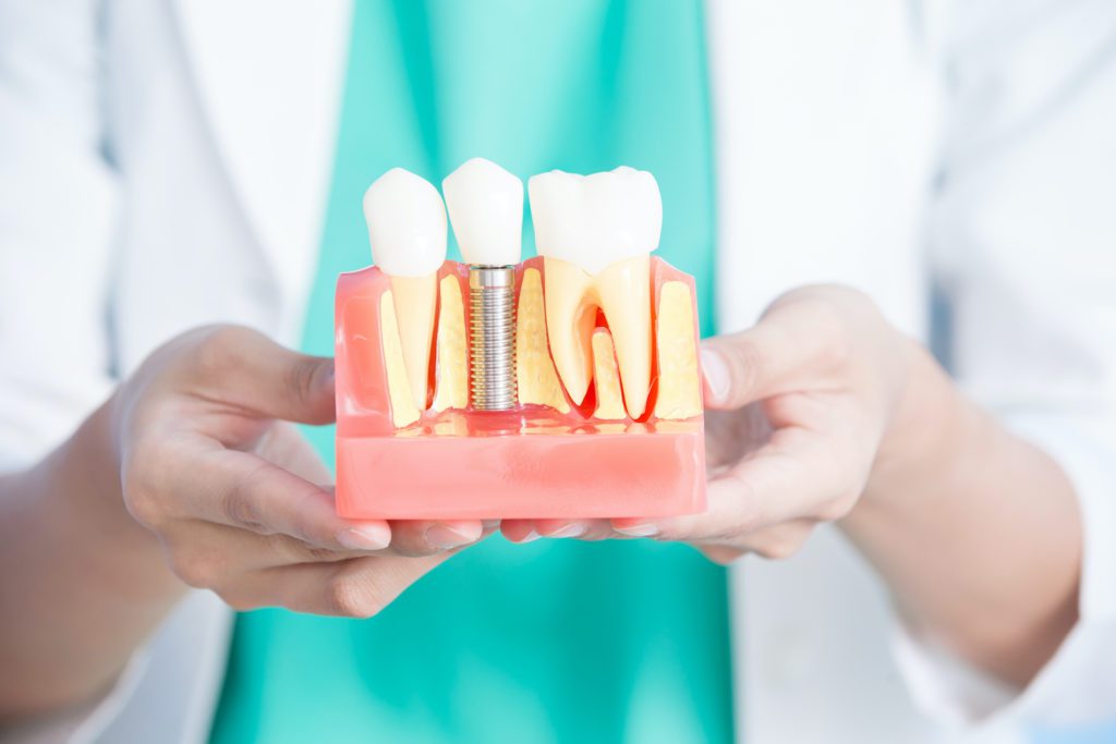 Here, we discuss Dental Implants vs Dentures In Chester Springs, PA