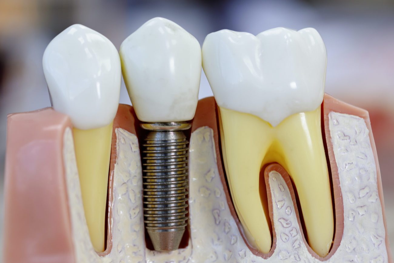 dental implants in coatesville, pennsylvania