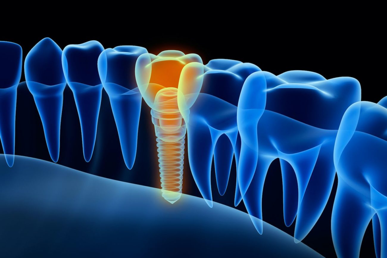 dental implants in main line, pennsylvania