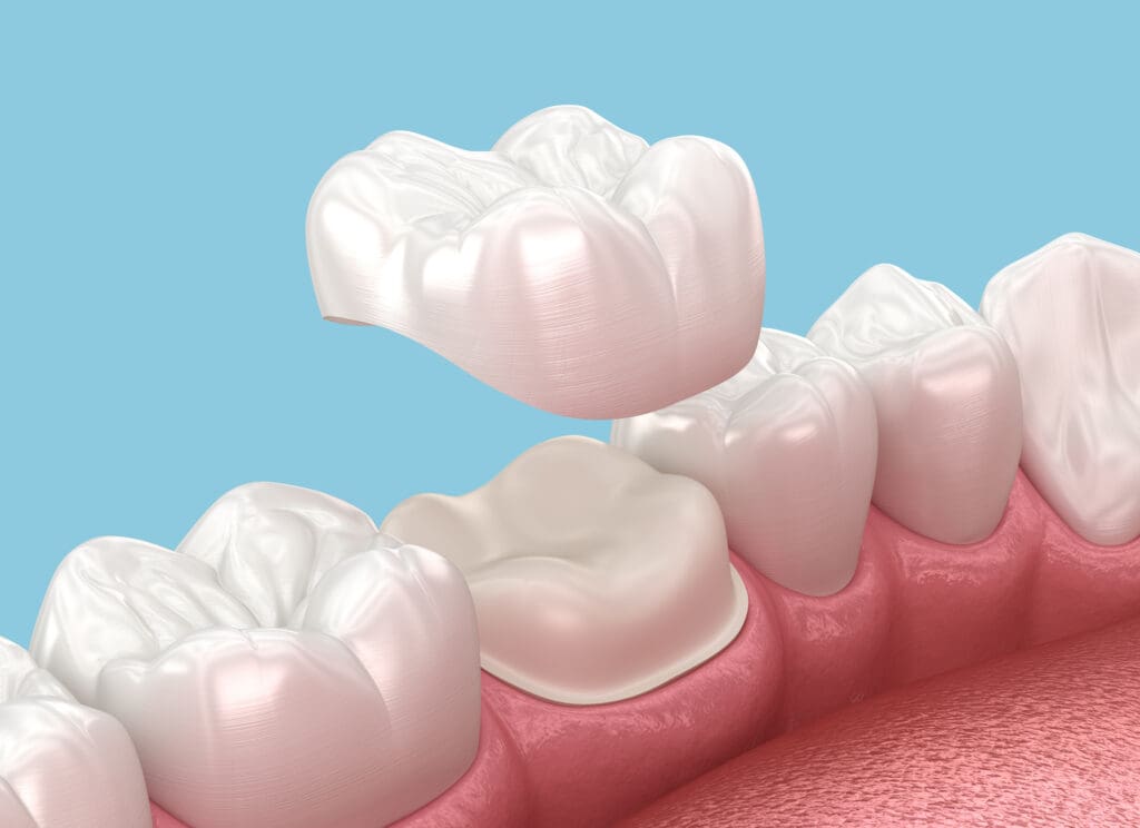The Many Uses of Dental Crowns