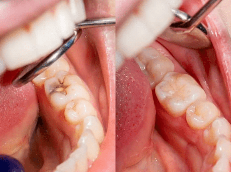 Side by side image of cavity before and after filling cavity prevention dentist in Chester Springs Pennsylvania