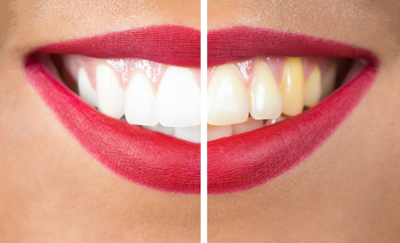 image of teeth before and after whitening cosmetic dentistry dentist in Chester Springs Pennsylvania 