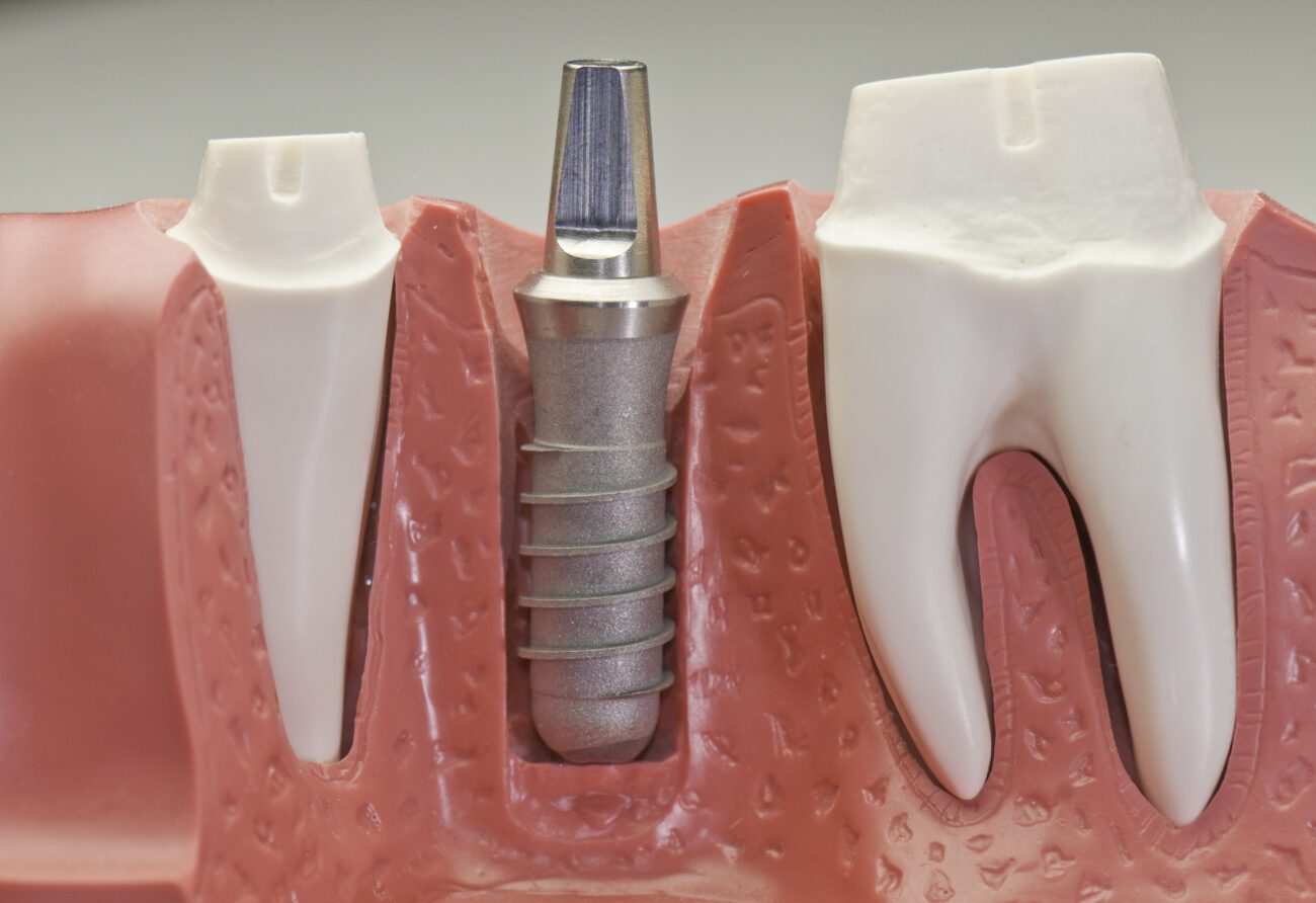 dental implants faqs chester springs pa