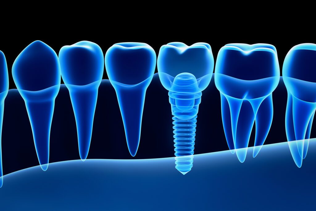 What are Dental Implants? Chester Springs, PA