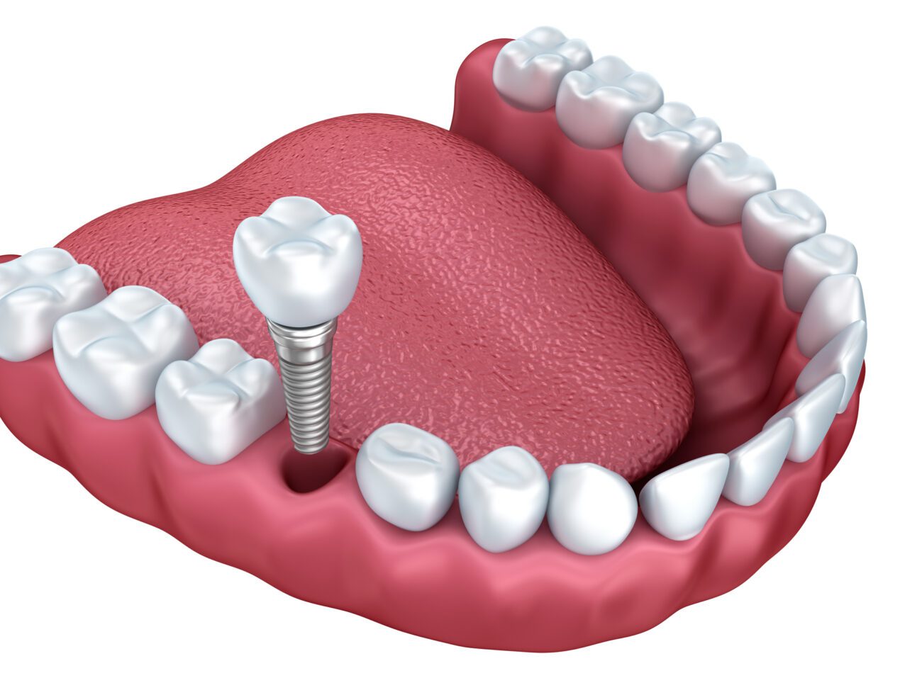 implant-supported crown in Chester Springs, PA