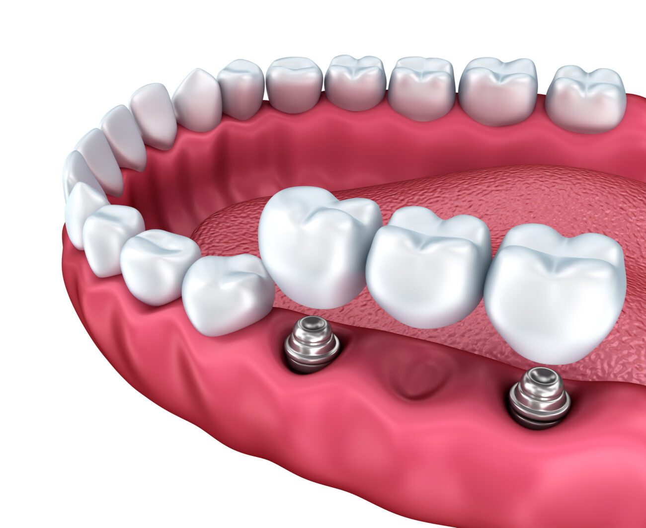 implant-supported bridges in Chester Springs, PA