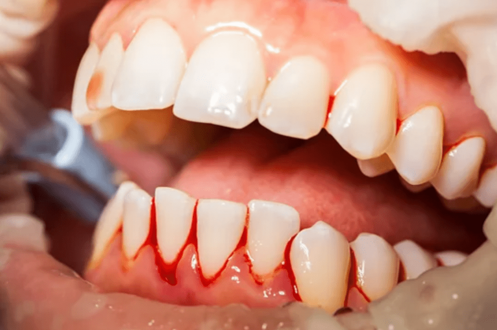 Why Gum Disease is Dangerous