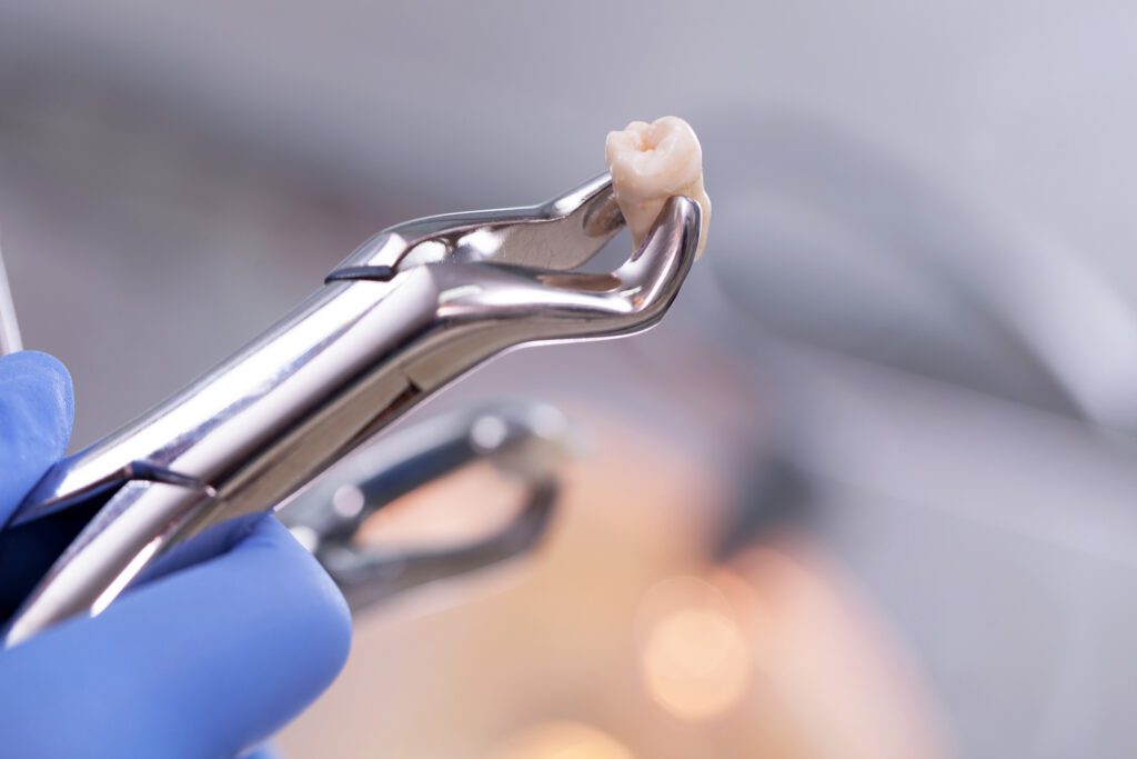 A TOOTH EXTRACTION in Chester Springs, PA, can help prevent further dental damage