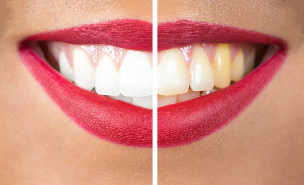 Teeth whitening in Chester Springs, PA, can help restore confidence in your smile