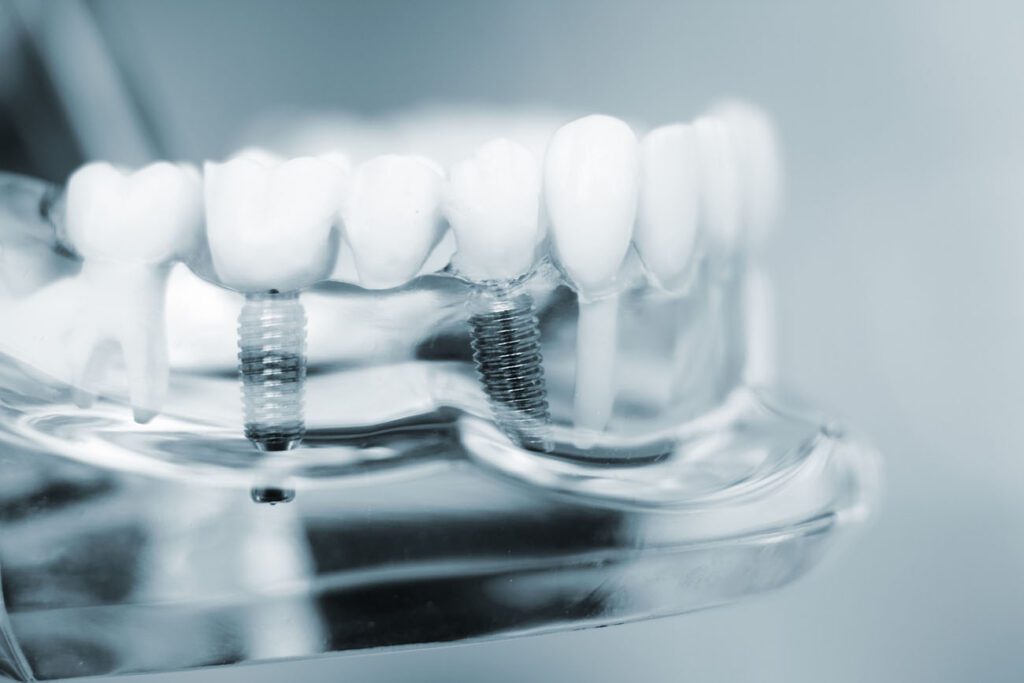 Dental bridges are a common solution for replacing missing teeth. They could help restore function and appearance.