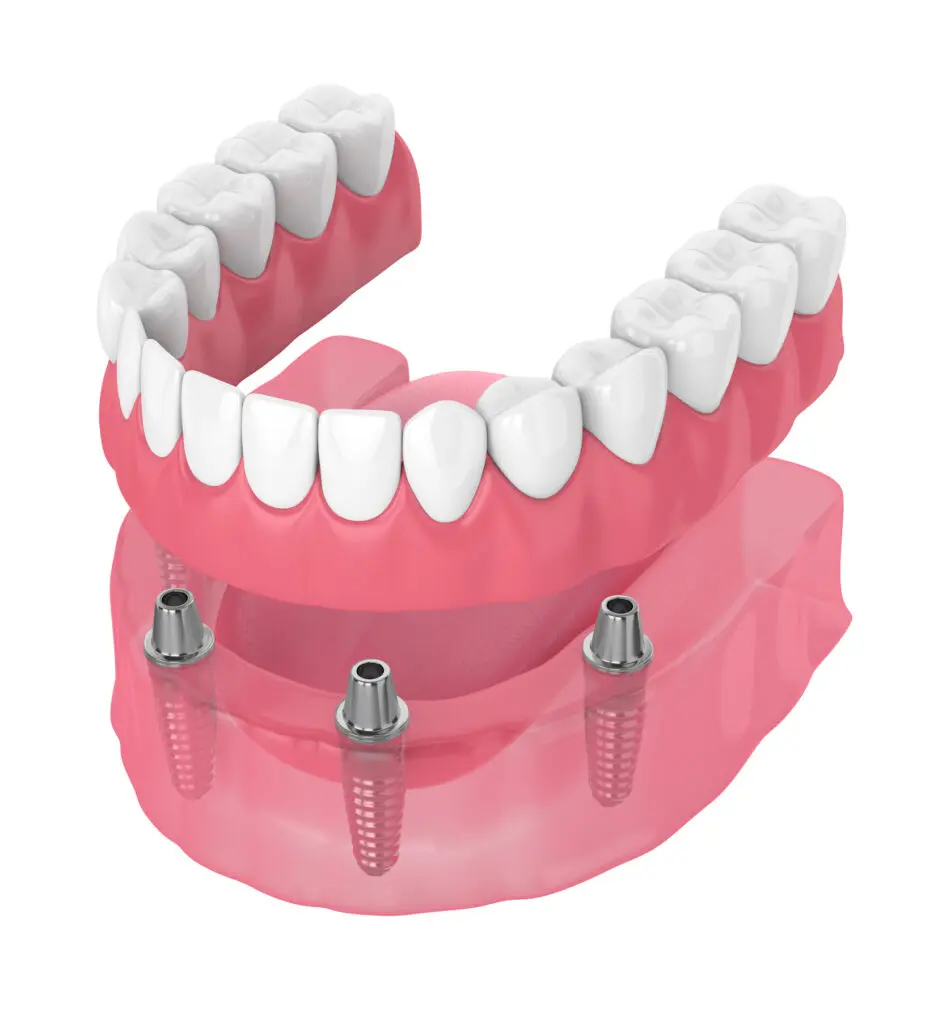 Traditional dentures often slip and cause discomfort. An Implant-secured denture often provides stability and comfort.