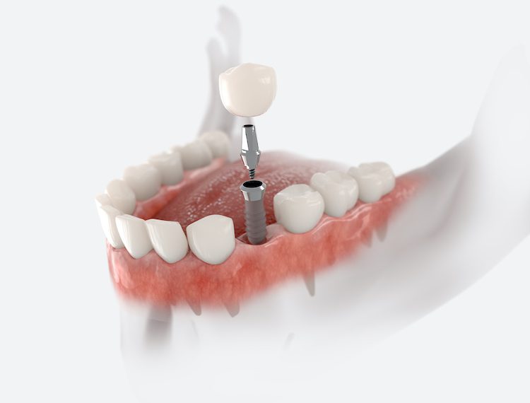 Several restoration options exist to fill the gap left after a tooth extraction. Understanding them enables you to make an informed decision.