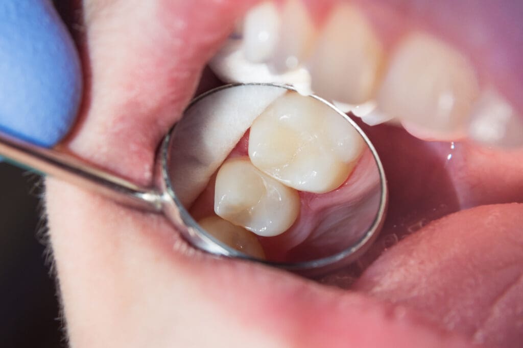 Cavities in Chester Springs PA