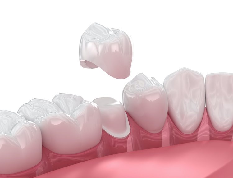 Knowing the specific situations in which a dental crown becomes necessary can help you make informed decisions about your oral health.