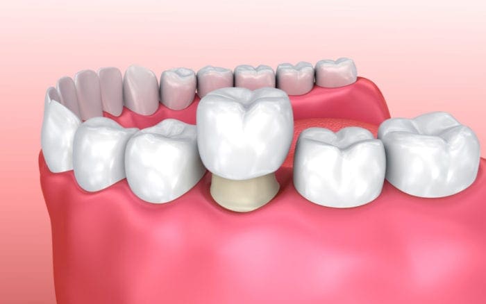 Dental Crown Treatment in Chester Springs PA