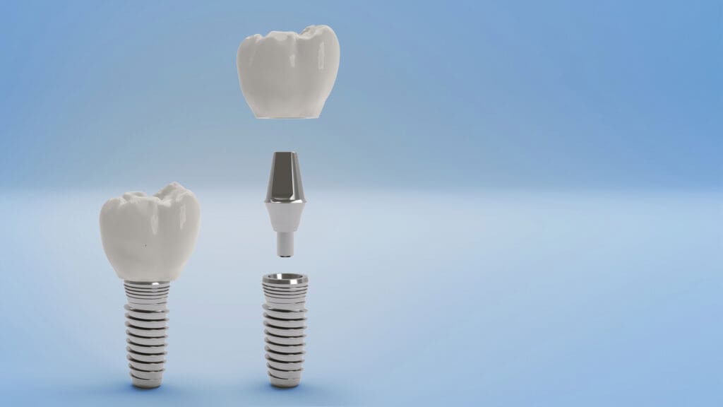 Dental Implants Exton PA
