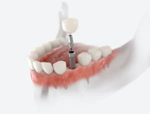 One Missing Tooth, Three Ways to Fix It in Chester Springs, PA
