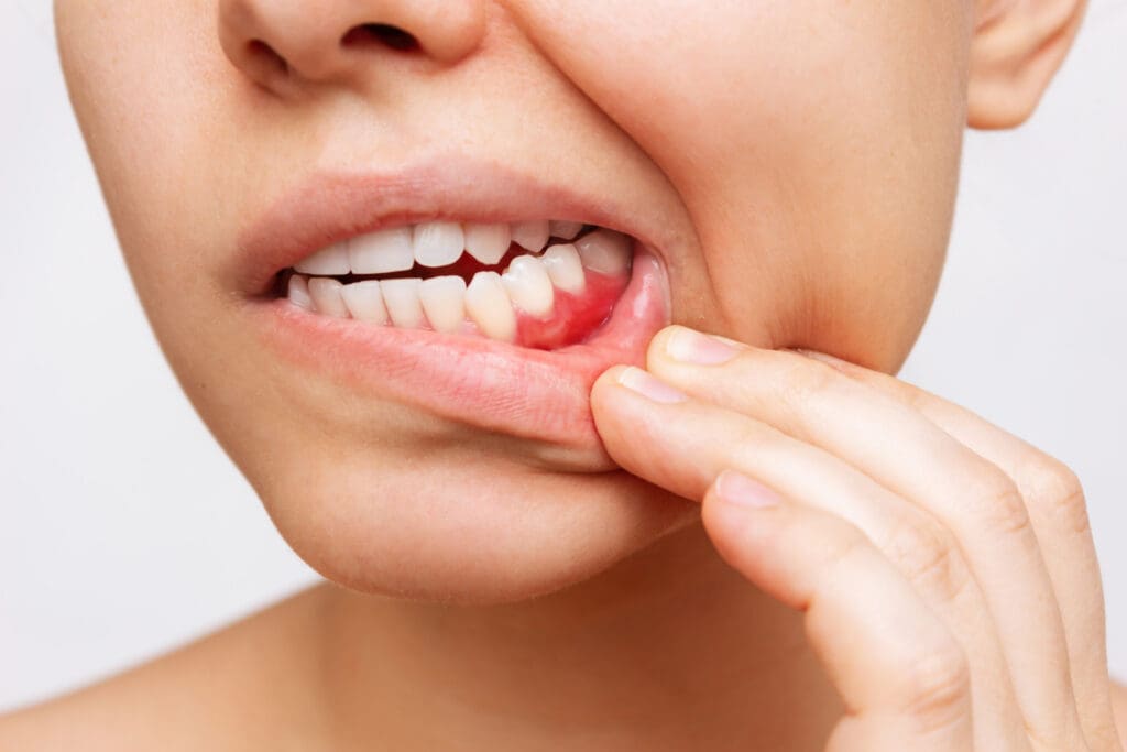 Treat Bleeding Gums in Chester Springs PA